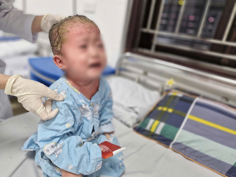 B&eacute; trai 2 tuổi trợt lo&eacute;t, chảy dịch khắp cơ thể do cha mẹ tự &yacute; l&agrave;m điều n&agrave;y- Ảnh 1.