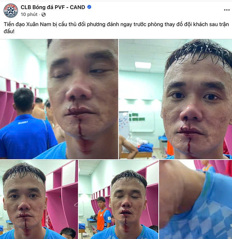 &ldquo;Dằn mặt&rdquo; đ&agrave;n em, cựu tiền đạo tuyển Việt Nam bị đấm chảy m&aacute;u mũi?- Ảnh 1.