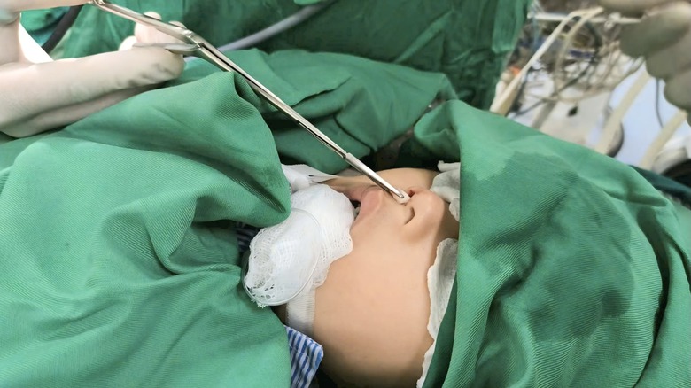 Hi hữu, răng mọc "lạc" l&ecirc;n mũi b&eacute; trai 4 tuổi ở Bắc Giang- Ảnh 2.