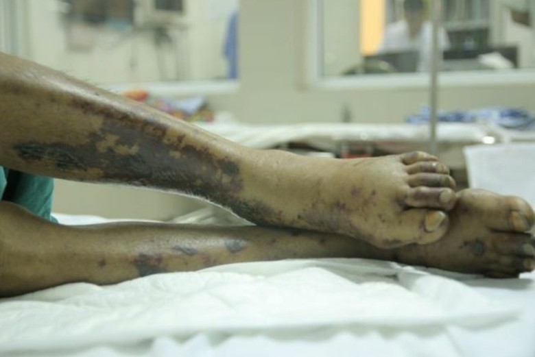 Mổ lợn chết, người đàn ông nguy kịch vì nhiễm liên cầu lợn- Ảnh 1. Mổ lợn chết, người đàn ông nguy kịch vì nhiễm liên cầu lợn- Ảnh 1.