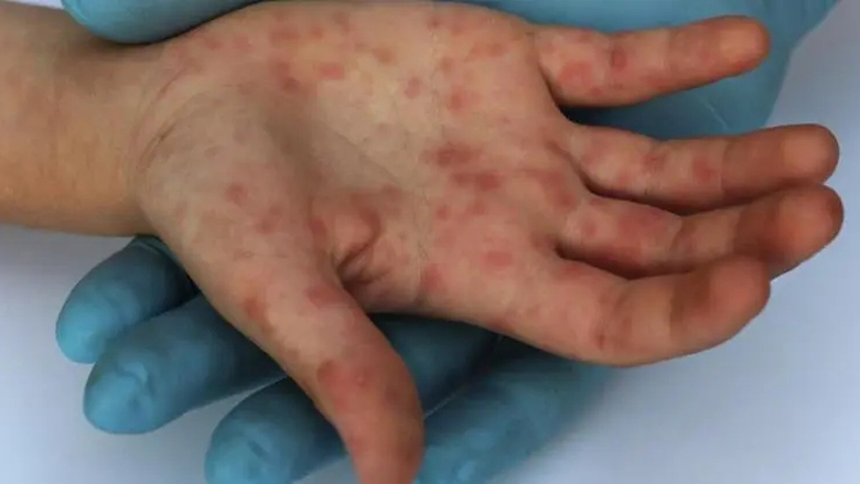 C&agrave; Mau c&ocirc;ng bố kết th&uacute;c ổ dịch đậu m&ugrave;a khỉ đầu ti&ecirc;n- Ảnh 1.