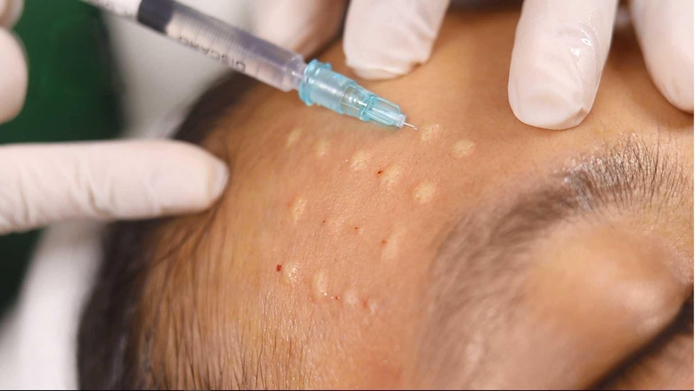 V&igrave; sao nhiều người ti&ecirc;m meso trẻ h&oacute;a da gặp biến chứng?- Ảnh 1.