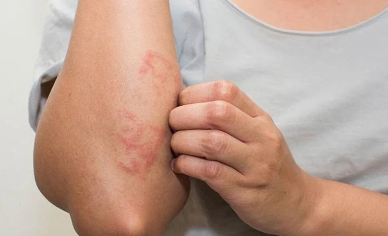 M&ugrave;a nồm ẩm, nhiều người bội nhiễm v&igrave; ngứa ng&aacute;y- Ảnh 1.