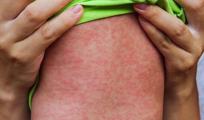 3 l&yacute; do khiến bệnh sởi dễ b&ugrave;ng dịch sau Tết- Ảnh 1.