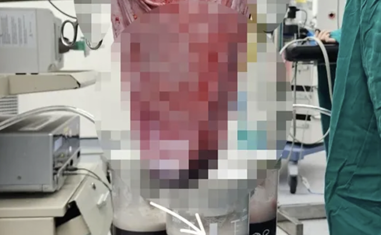 B&oacute;c t&aacute;ch th&agrave;nh c&ocirc;ng khối u buồng trứng 10kg cho c&ocirc; g&aacute;i 19 tuổi- Ảnh 1.