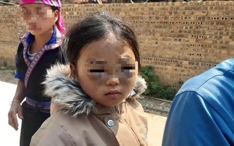 C&ocirc;ng an Y&ecirc;n B&aacute;i v&agrave;o cuộc điều tra vụ b&eacute; lớp 1 nghi bị c&ocirc; gi&aacute;o "t&aacute;c động" t&iacute;m mắt- Ảnh 1.