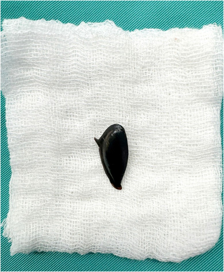 Cụ b&agrave; 90 tuổi nguy kịch v&igrave; h&oacute;c hạt hồng xi&ecirc;m- Ảnh 1.