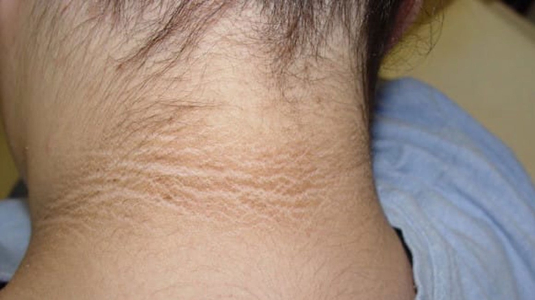 Trẻ b&eacute;o ph&igrave; c&oacute; vệt đen v&ugrave;ng cổ, c&oacute; đ&aacute;ng lo?- Ảnh 1.