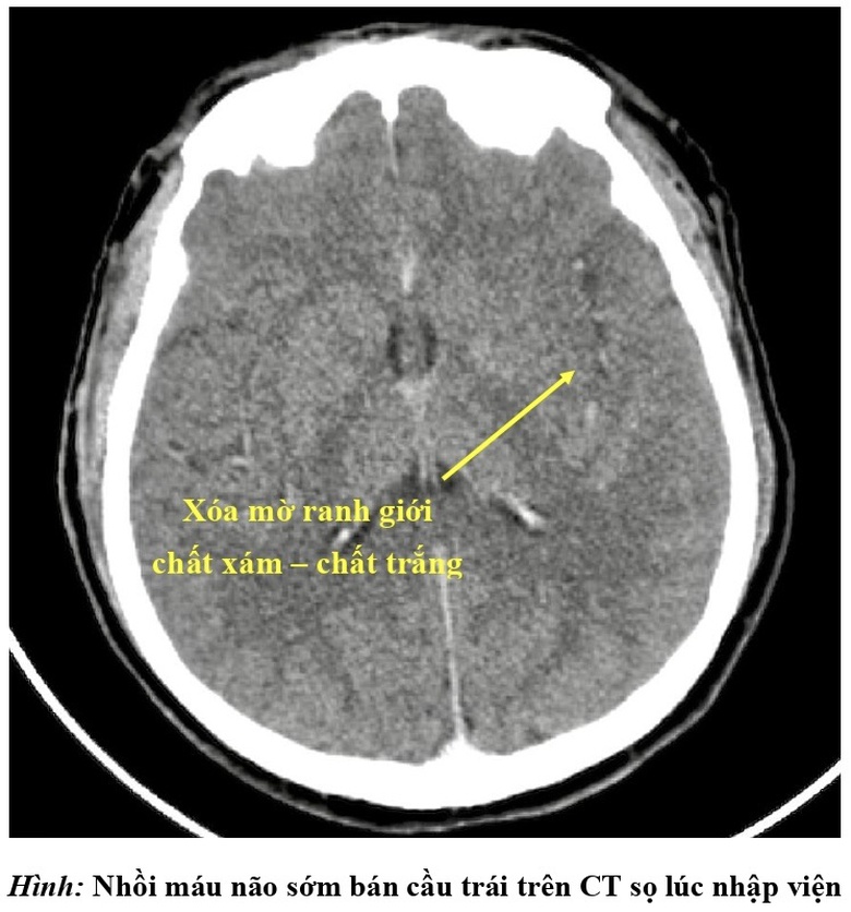 Người đ&agrave;n &ocirc;ng đột quỵ sau khi gi&aacute;c hơi chữa đau lưng, đau vai g&aacute;y tại nh&agrave;- Ảnh 2.