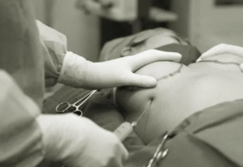 N&acirc;ng ngực bằng mỡ tự th&acirc;n, một phụ nữ mưng mủ hai b&ecirc;n ngực, nhiễm tr&ugrave;ng da- Ảnh 1.