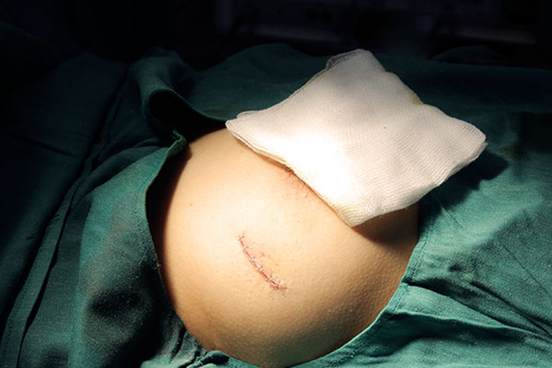 U tuyến v&uacute; cần phẫu thuật khi n&agrave;o?- Ảnh 1.