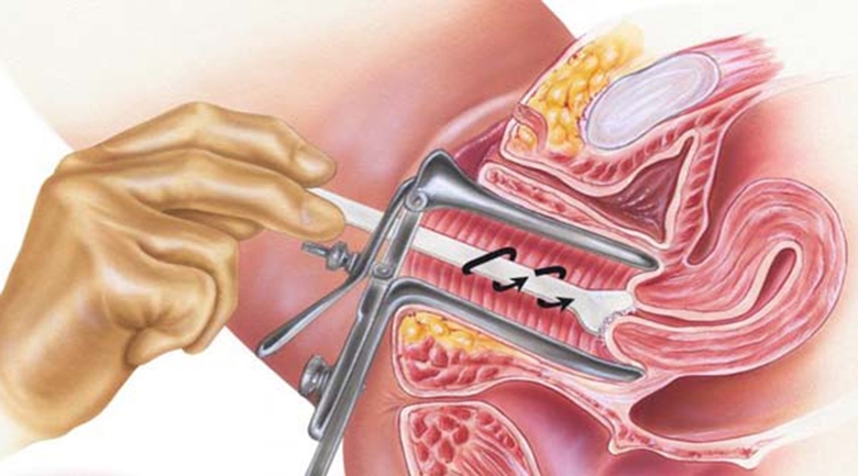 Ung thư cổ tử cung c&oacute; thể tầm so&aacute;t sớm?- Ảnh 1.