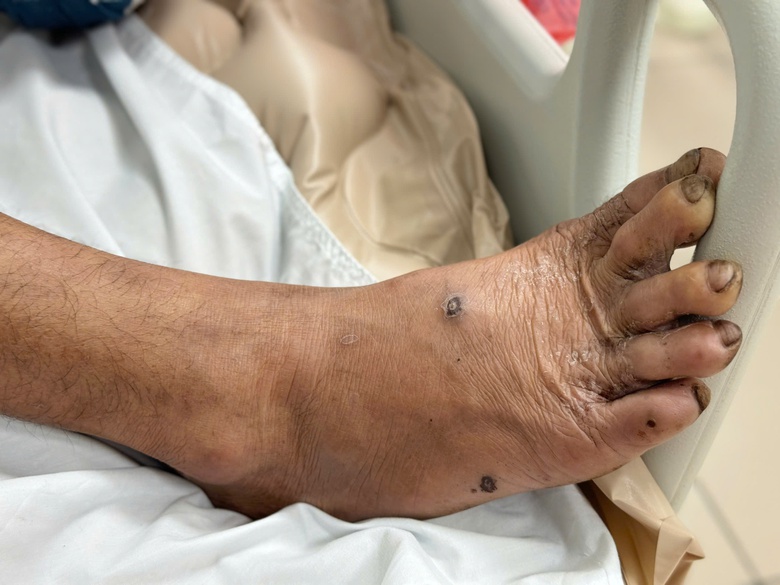 Nhập viện cấp cứu v&igrave; gạch rơi v&agrave;o mu b&agrave;n ch&acirc;n g&acirc;y uốn v&aacute;n- Ảnh 2.