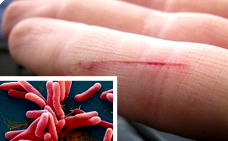 C&aacute;ch n&agrave;o ph&ograve;ng nhiễm khuẩn &ldquo;ăn thịt người&rdquo;?- Ảnh 1.