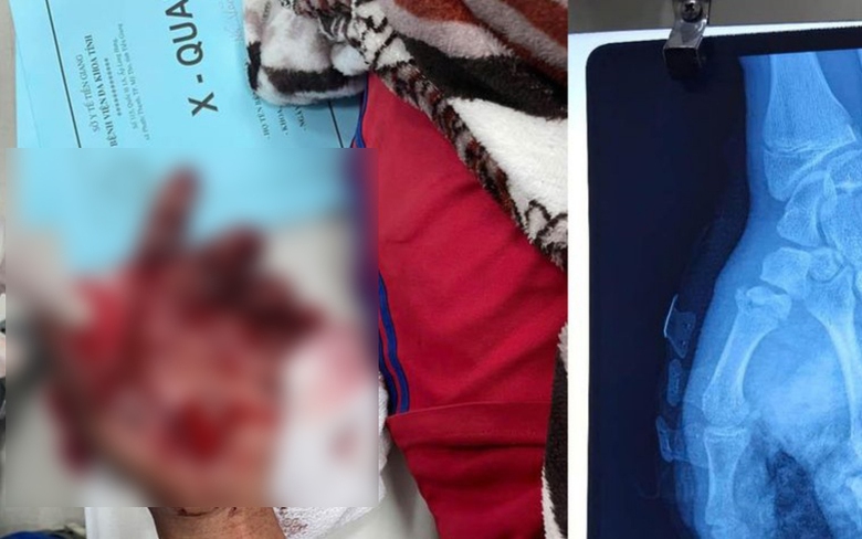 Đốt ph&aacute;o đ&ecirc;m giao thừa, b&eacute; trai 14 tuổi ở Tiền Giang bị giập n&aacute;t b&agrave;n tay- Ảnh 1.