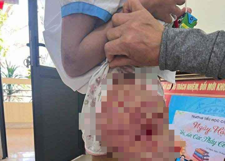 Bắt giữ khẩn cấp người cha dượng bạo hành con riêng ở Hà Tĩnh- Ảnh 3. Bắt giữ khẩn cấp người cha dượng bạo hành con riêng ở Hà Tĩnh- Ảnh 3.