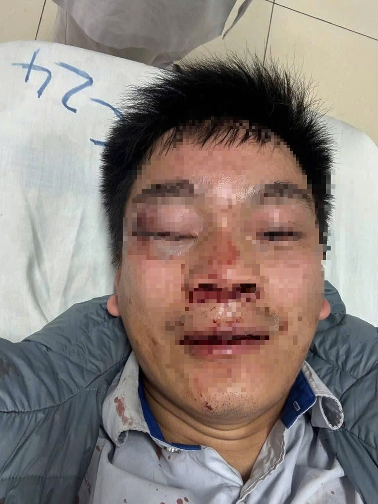 Va chạm khi dừng đón khách, lái xe buýt bị hành hung phải nhập viện- Ảnh 1. Va chạm khi dừng đón khách, lái xe buýt bị hành hung phải nhập viện- Ảnh 1.