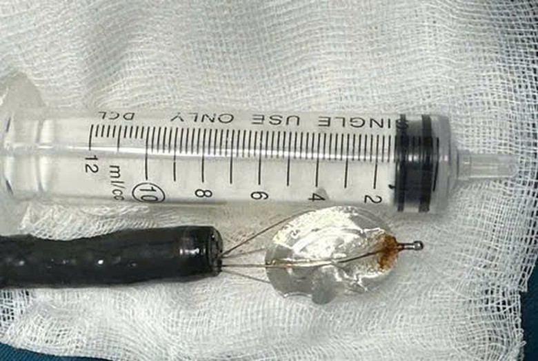 B&eacute; trai 11 tuổi nuốt nắp lon nước ngọt g&acirc;y tắc nghẽn dạ d&agrave;y- Ảnh 1.