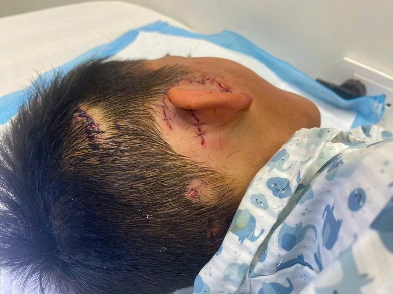 Một b&eacute; trai 8 tuổi su&yacute;t mất v&agrave;nh tai phải do bị ch&oacute; nh&agrave; cắn- Ảnh 1.