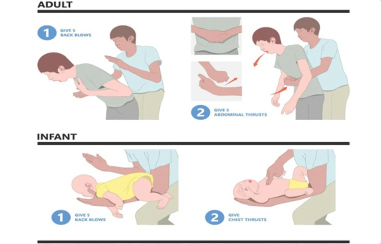 Hi hữu, cụ &ocirc;ng vỡ dạ d&agrave;y do sơ cứu h&oacute;c dị vật sai c&aacute;ch- Ảnh 2.