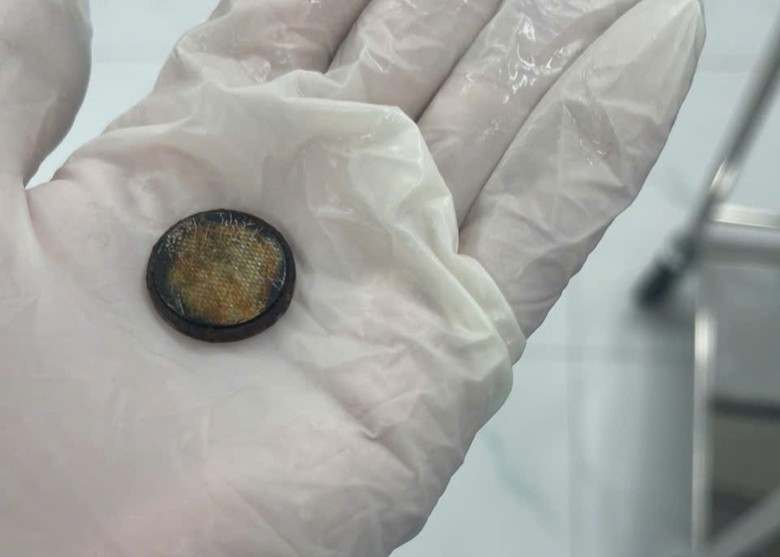 Trẻ su&yacute;t thủng thực quản, gi&agrave; &aacute;p xe gan nguy kịch v&igrave; h&oacute;c dị vật- Ảnh 3.