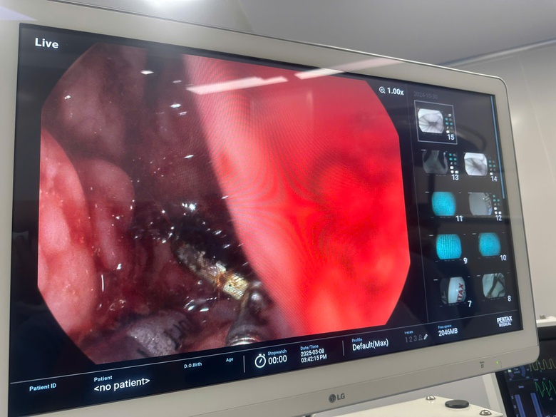 Trẻ su&yacute;t thủng thực quản, gi&agrave; &aacute;p xe gan nguy kịch v&igrave; h&oacute;c dị vật- Ảnh 4.