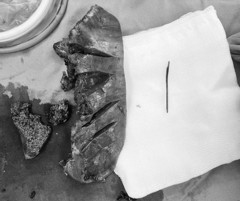 Trẻ su&yacute;t thủng thực quản, gi&agrave; &aacute;p xe gan nguy kịch v&igrave; h&oacute;c dị vật- Ảnh 1.