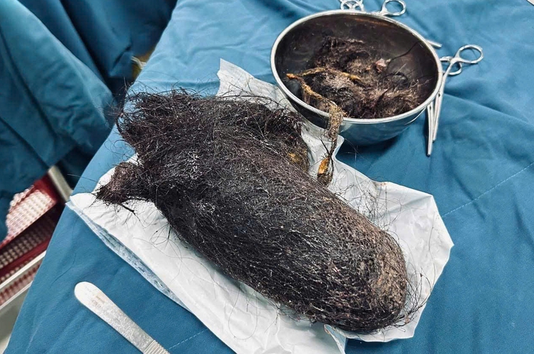 B&uacute;i t&oacute;c nặng gần 1kg nằm chắn ngang dạ d&agrave;y b&eacute; g&aacute;i 12 tuổi- Ảnh 1.