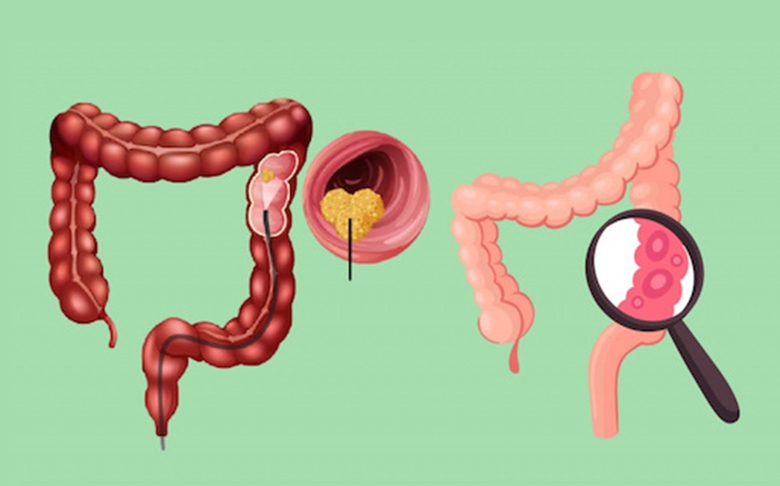C&aacute;ch n&agrave;o để kiểm so&aacute;t ung thư đại tr&agrave;ng?- Ảnh 1.