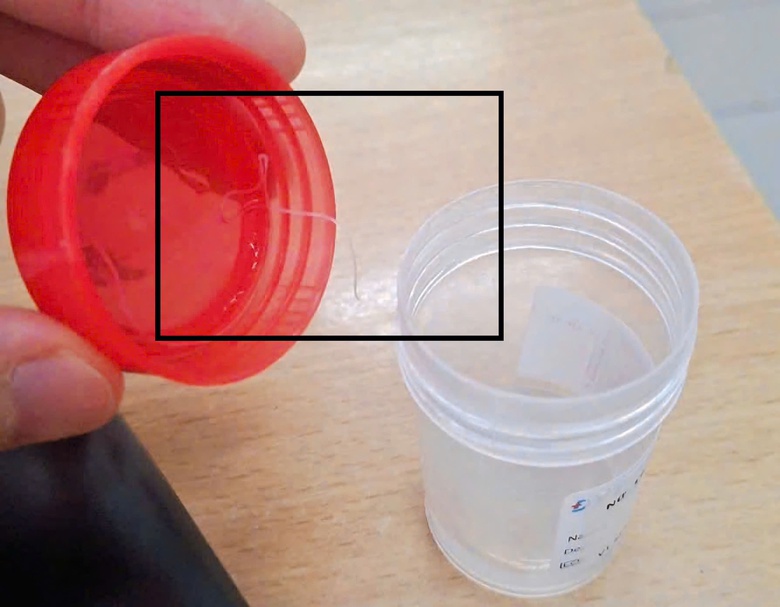 Ph&aacute;t hiện k&yacute; sinh tr&ugrave;ng d&agrave;i gần 10cm trong mắt một phụ nữ- Ảnh 2.