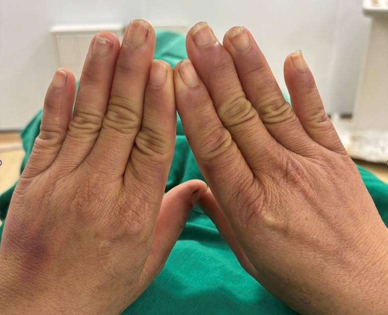 Mắc hội chứng lạ, người phụ nữ đau đớn mỗi khi chạm tay v&agrave;o nước- Ảnh 2.