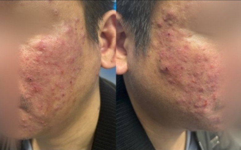 Tưởng mụn trứng cá, người đàn ông bất ngờ phát hiện viêm da do ký sinh trùng ít người biết- Ảnh 1. Tưởng mụn trứng cá, người đàn ông bất ngờ phát hiện viêm da do ký sinh trùng ít người biết- Ảnh 1.