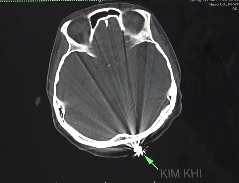 Người phụ nữ Cần Thơ bị vi&ecirc;n đạn lạc găm v&agrave;o đầu l&uacute;c đi l&agrave;m vườn- Ảnh 1.
