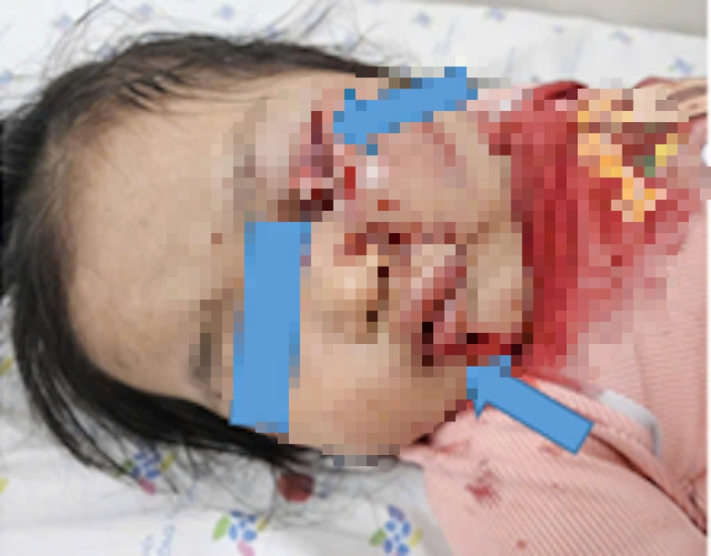Mẹ kh&ocirc;ng tắt m&aacute;y xe, b&eacute; 26 th&aacute;ng tuổi dập phổi, r&aacute;ch m&iacute; mắt v&igrave; vặn tay ga - Ảnh 1.