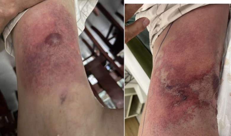 Chủ quan với vết thương nhỏ khi tắm biển, nam trung ni&ecirc;n su&yacute;t mất mạng- Ảnh 2.