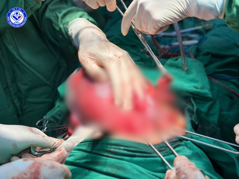 Cấp cứu th&agrave;nh c&ocirc;ng sản phụ bị vỡ ruột thừa v&ocirc; c&ugrave;ng nguy kịch- Ảnh 2.