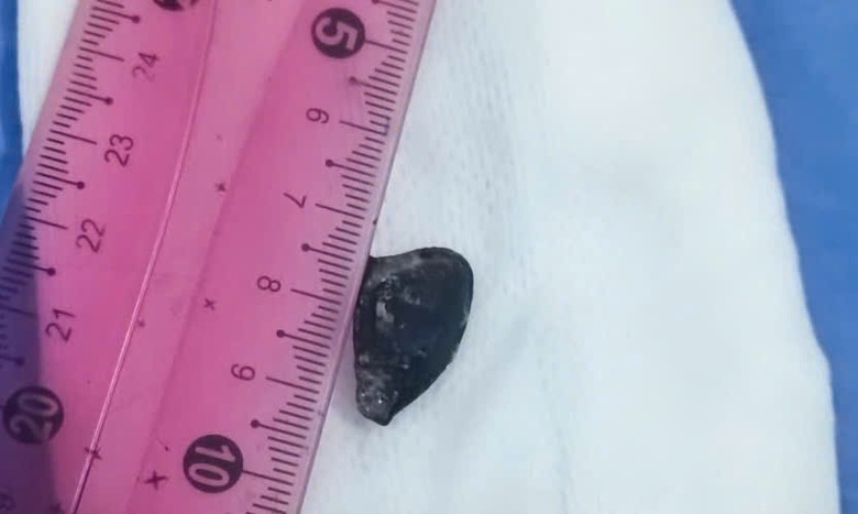 Hy hữu người đ&agrave;n &ocirc;ng "bỏ qu&ecirc;n" hạt sap&ocirc;ch&ecirc; 10 năm trong phế quản- Ảnh 2.