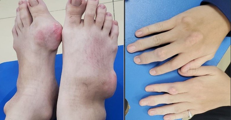 Khớp ngón tay, chân nam thanh niên biến dạng vì bệnh gout- Ảnh 1. Khớp ngón tay, chân nam thanh niên biến dạng vì bệnh gout- Ảnh 1.