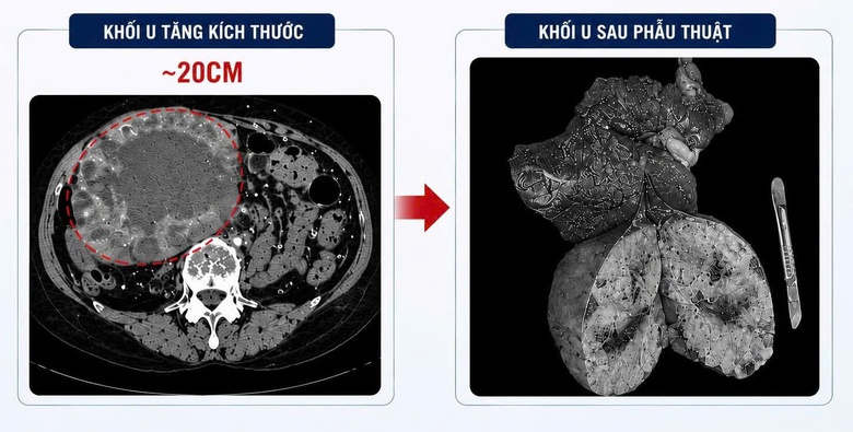 Tự &yacute; uống thuốc nam, một phụ nữ nhập viện với khối u gan 20cm- Ảnh 2.