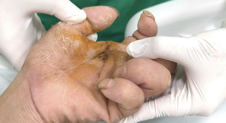 Bị gà mổ vào chân, cụ ông 94 tuổi nguy kịch vì uốn ván - Ảnh 2.