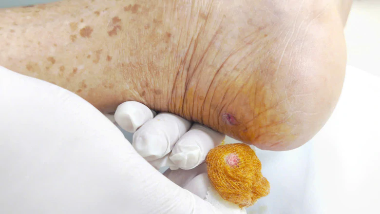 Bị gà mổ vào chân, cụ ông 94 tuổi nguy kịch vì uốn ván - Ảnh 3.