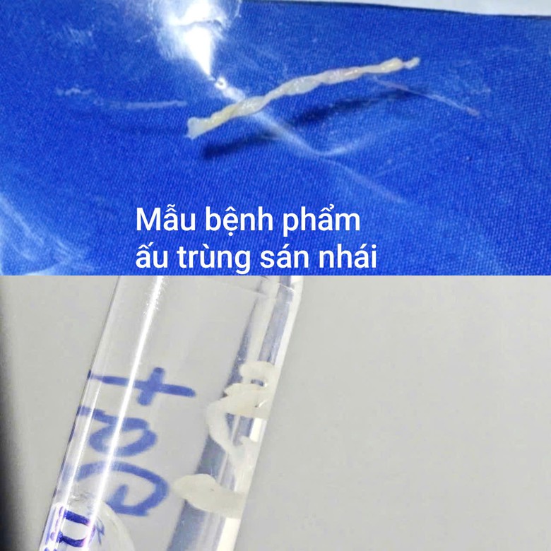 Sau tắm suối nam trung ni&ecirc;n nhiễm ấu tr&ugrave;ng s&aacute;n nh&aacute;i hiếm gặp - Ảnh 2.