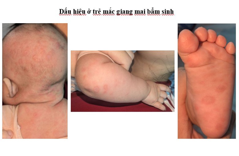 Cảnh báo nhiều trẻ mắc giang mai bẩm sinh - Ảnh 1.