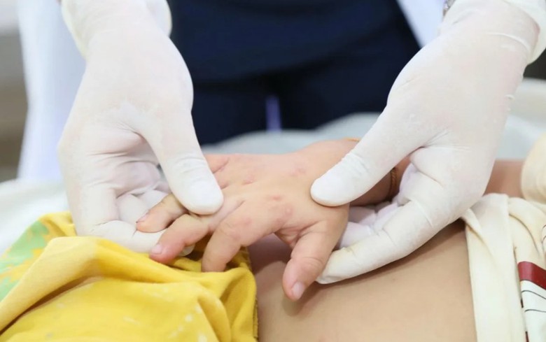 M&ugrave;a tựu trường, lưu &yacute; 4 nh&oacute;m bệnh c&oacute; nguy cơ tăng cao - Ảnh 2.