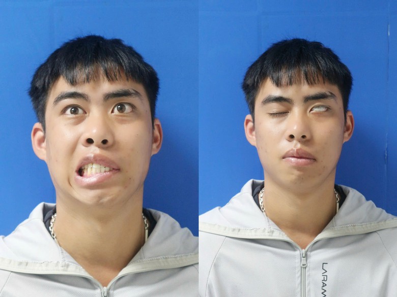 Trả lại nụ cười v&agrave; sự tự tin cho nam thanh ni&ecirc;n liệt mặt 7 năm sau phẫu thuật u n&atilde;o - Ảnh 1.