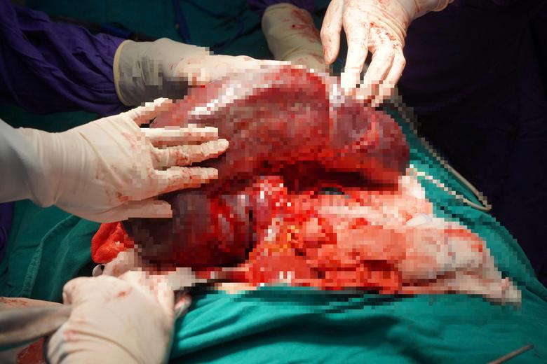 Gia Lai: Cắt th&agrave;nh c&ocirc;ng l&aacute; l&aacute;ch khổng lồ nặng 3,5kg, gấp 20 lần b&igrave;nh thường - Ảnh 2.