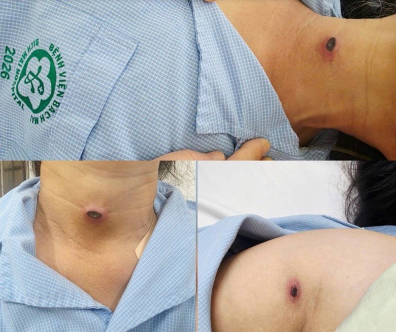 Ph&aacute;t hiện sốt m&ograve; từ vết thương nhỏ x&iacute;u - Ảnh 1.