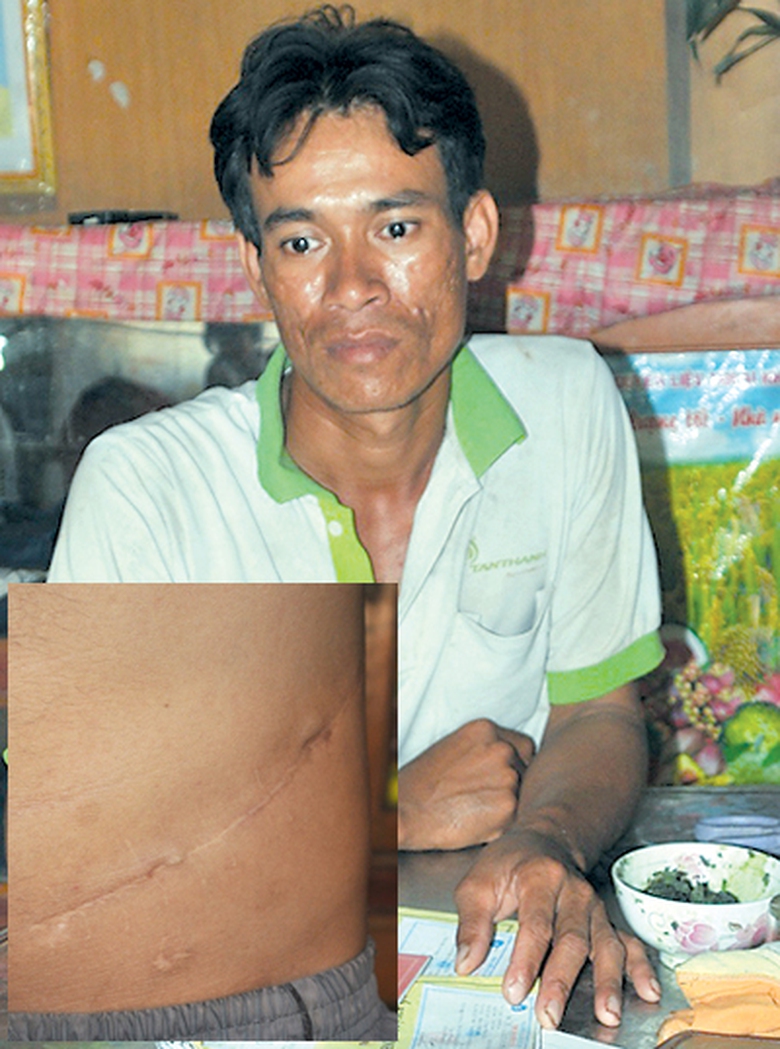 Danh Lan c&ugrave;ng vết mổ hiến thận tr&ecirc;n bụng