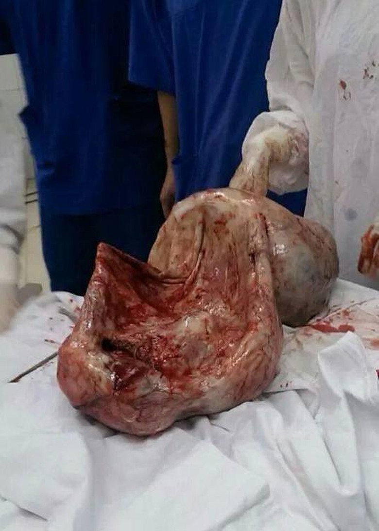 Sau khi được lấy ra, khối u nặng 7 kg c&ugrave;ng với 16 l&iacute;t dịch