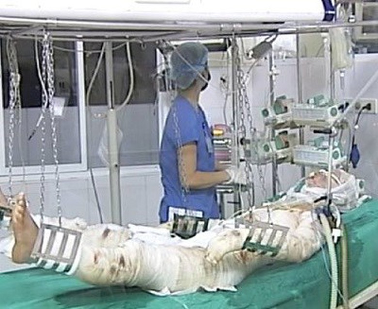 Nạn nh&acirc;n vụ m&aacute;y bay rơi ở H&ograve;a Lạc được chăm s&oacute;c tại Viện Bỏng Quốc gia. (Ảnh: TTXVN)